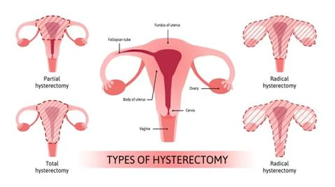 أسباب وإجراءات عملية استئصال الرحم وما بعد