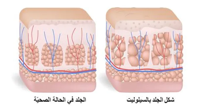 ما هو السيلوليت؟ أسباب السيلوليت وطرق