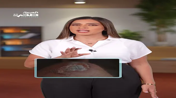 إصابة بشرية بالدودة الحلزونية الآكلة للحوم