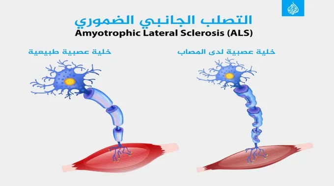 ما هو التصلب الضموري العضلي الجانبي؟